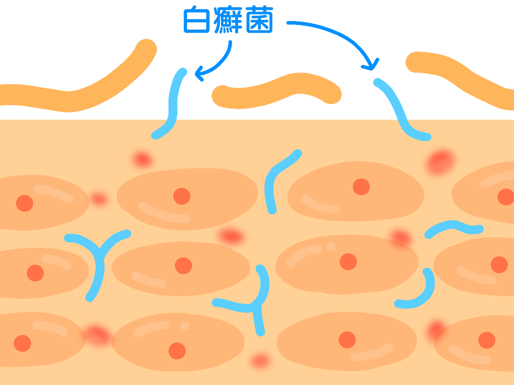 カビによる感染症が原因の白癬