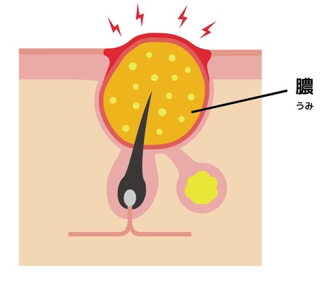 黄ニキビ