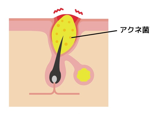 赤ニキビ