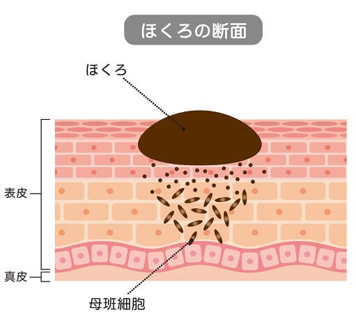 ほくろの原因