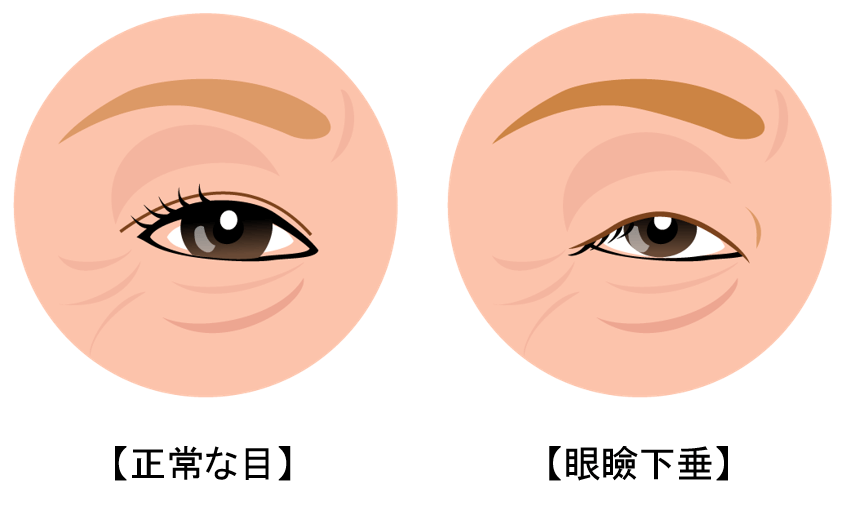 瞼が重い・開かない眼瞼下垂症